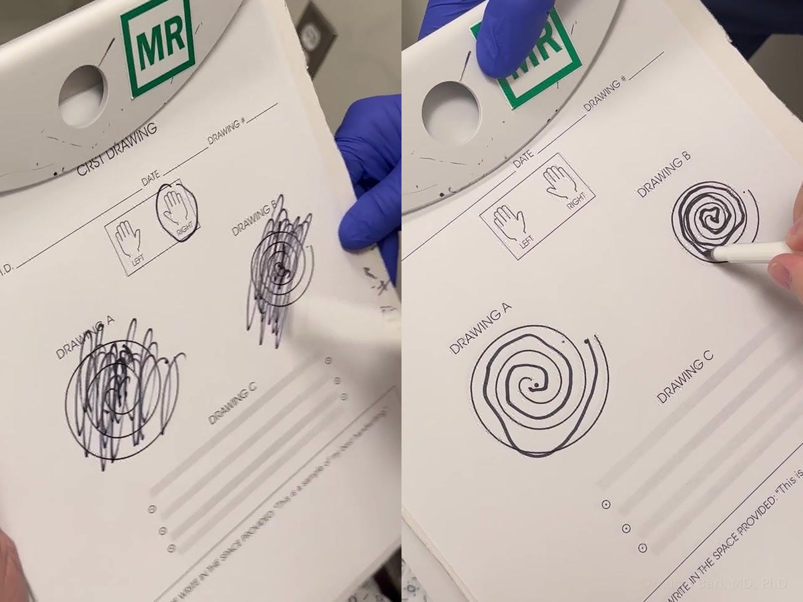 Spirals drawn by one of Dr. Bari’s patients with essential tremor: shaky, broken loops before treatment on the left and smooth, even spirals after treatment on the right