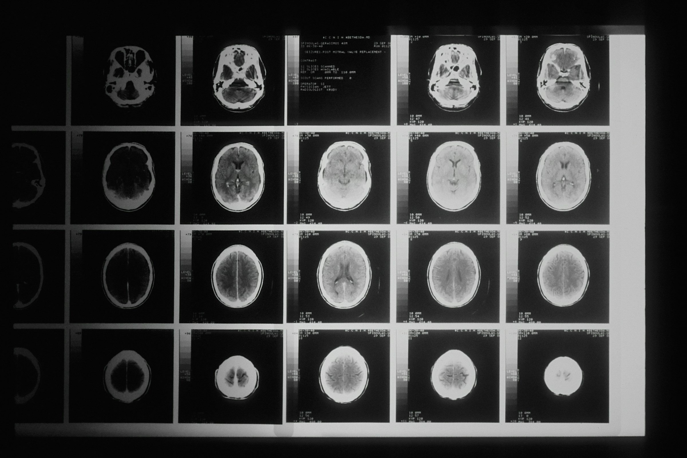 A film of head CT images on a light box
